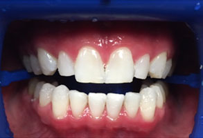 Norwalk Dental Center | Teeth Whitening, Night Guards and Periodontal Treatment