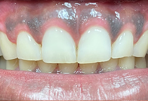 Norwalk Dental Center | Emergency Treatment, Night Guards and Orthodontics