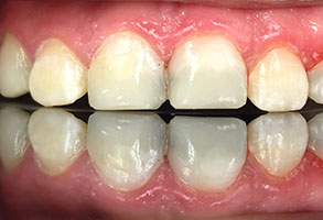 Norwalk Dental Center | Root Canals, Sports Mouthguards and Dental Cleanings