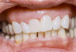 Dental Implants Dentist Norwalk CA