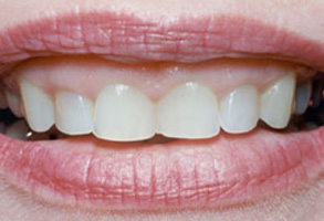 Dental Implants Dentist Norwalk CA