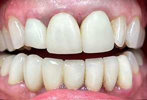 Norwalk Dental Center | Dental Fillings, Periodontal Treatment and Dentures