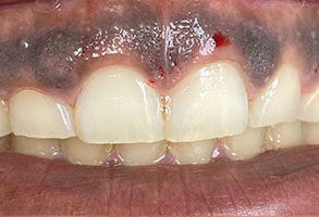 Norwalk Dental Center | Implant Dentistry, Teeth Whitening and Sports Mouthguards