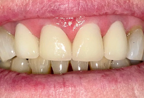 Norwalk Dental Center | Dental Fillings, Preventative Program and Dental Bridges