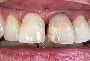 Norwalk Dental Center | Extractions, Dental Bridges and Teeth Whitening