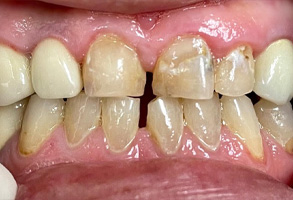 Norwalk Dental Center | Night Guards, Oral Exams and Dental Cleanings