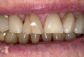 Norwalk Dental Center | Dental Bridges, Emergency Treatment and Crowns  amp  Caps